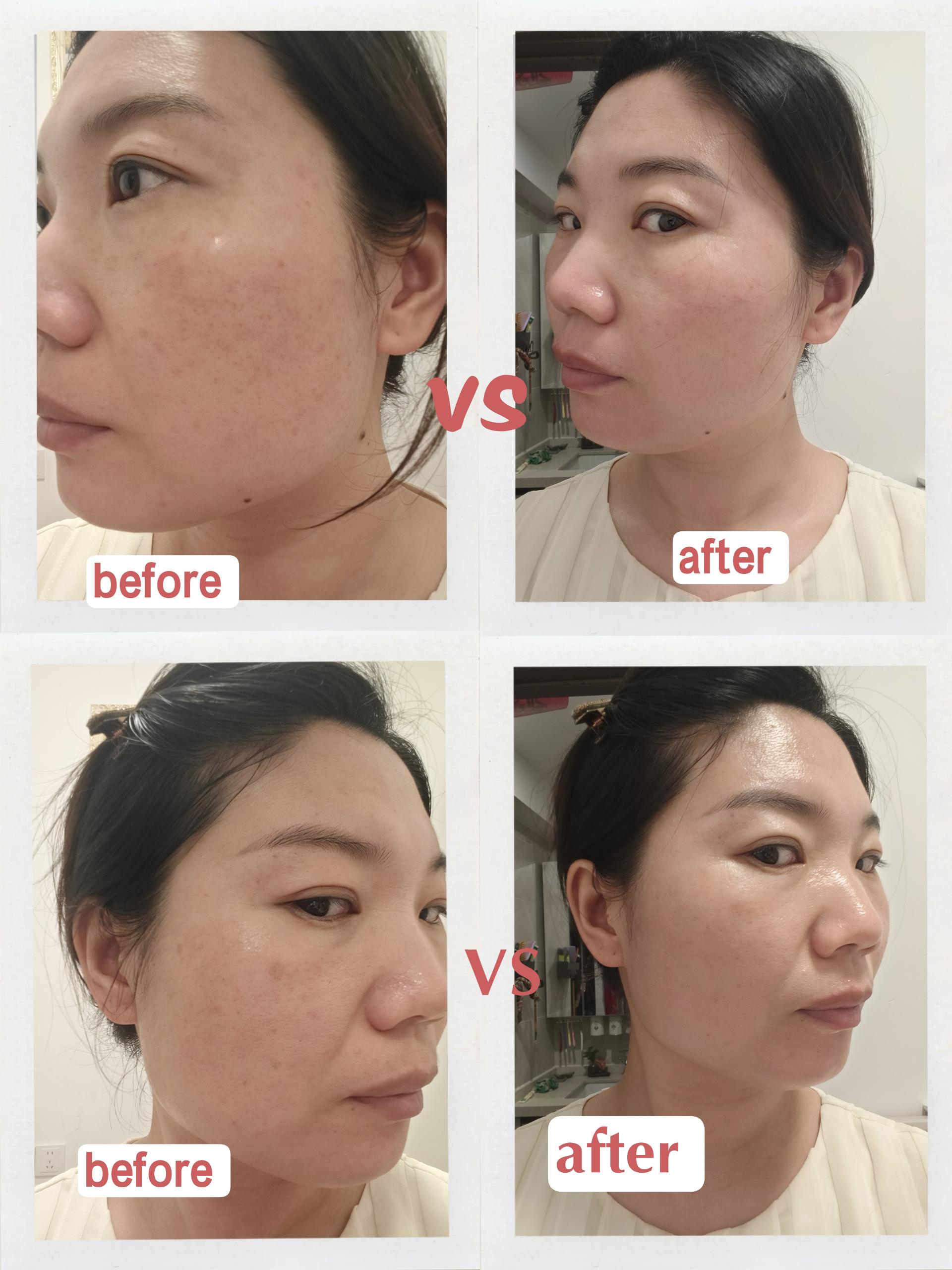 How Long to See Results from a Red Light Mask Red light therapy mask results timeline: glow at 2 weeks, collagen remodeling at 6-12 weeks, maintenance after 12 weeks