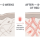 Red light therapy skin tightening: cross-section comparison showing thinner collagen before treatment and denser, firmer collagen after 8-12 weeks of consistent red light sessions