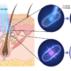 Blue 415nm light destroying acne-causing bacteria inside a skin pore through porphyrin activation