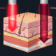 Cross-section showing red light penetrating to dermis and near-infrared penetrating to muscle and joints