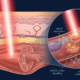 Illustration of near-infrared light reaching mitochondria in muscle cells to boost cellular repair